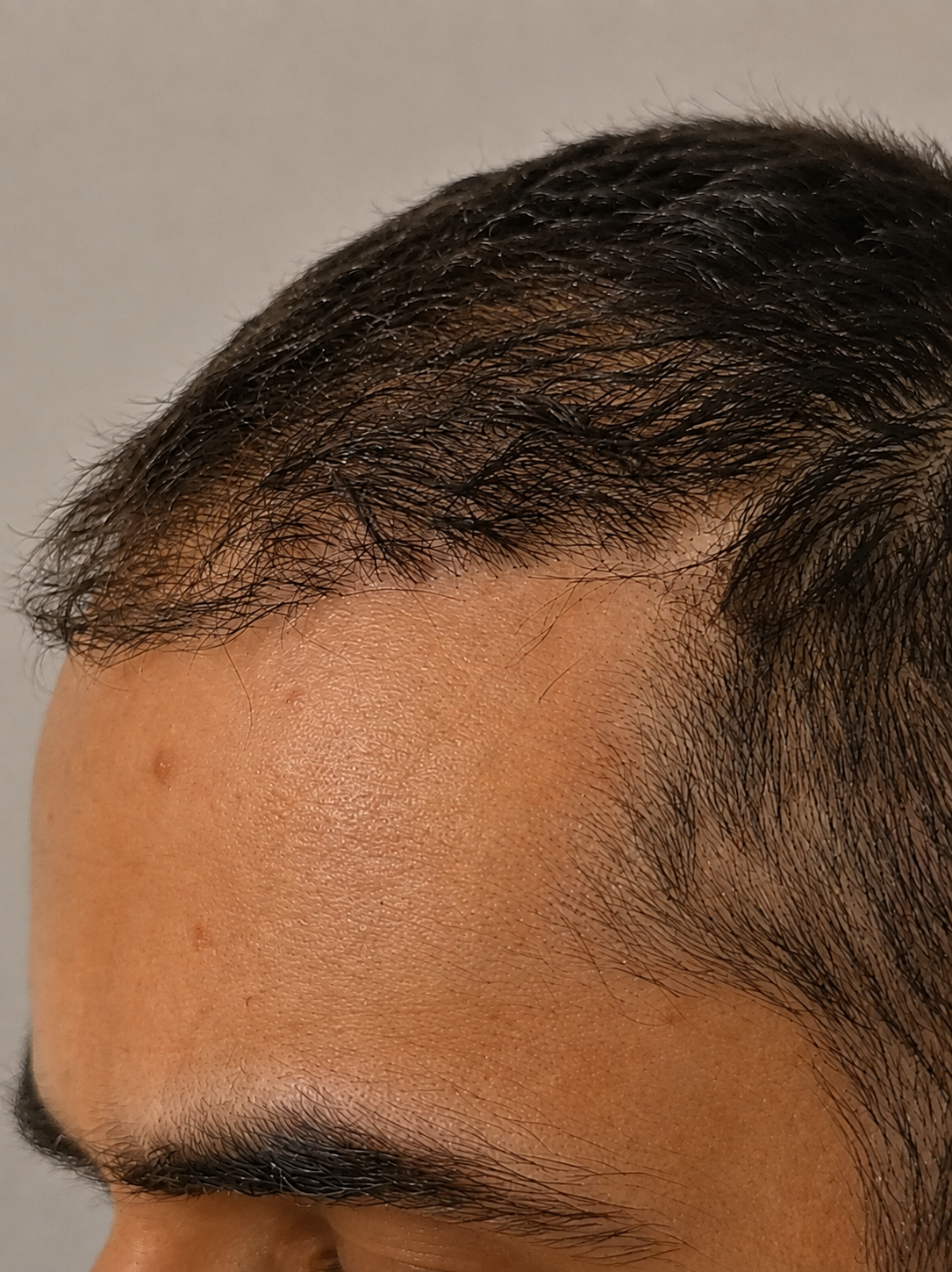 Visible thinning and patchy growth near the hairline